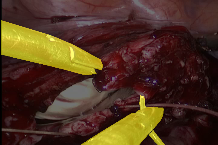 suturing
