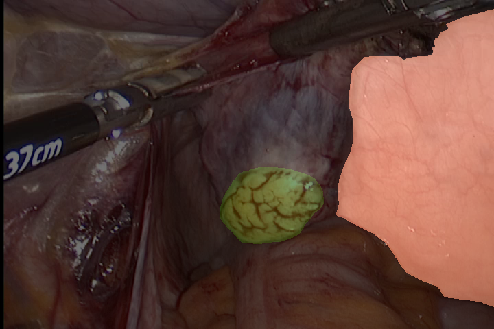 uterus_ovary