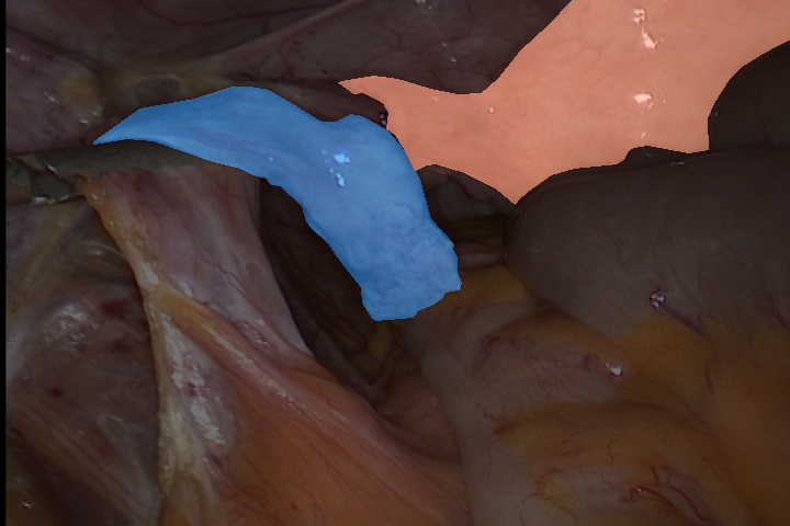 uterus and tube